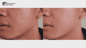 Skin Rise Face Whitening Creams Results